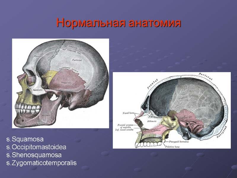 Нормальная анатомия s.Squamosa s.Occipitomastoidea s.Shenosquamosa s.Zygomaticotemporalis